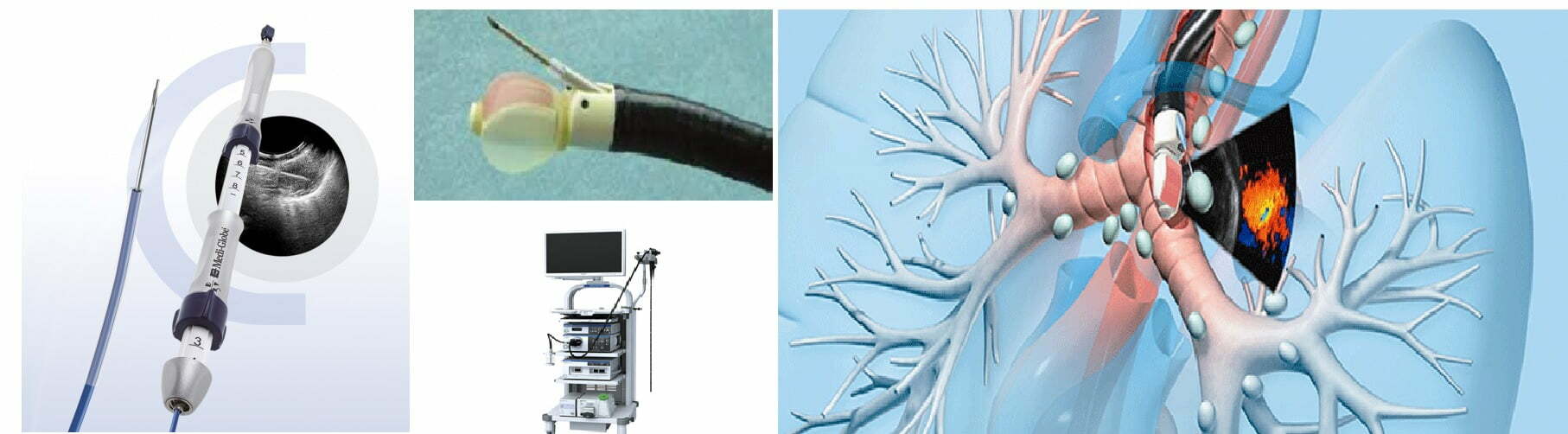 EBUS Bronchoscopy