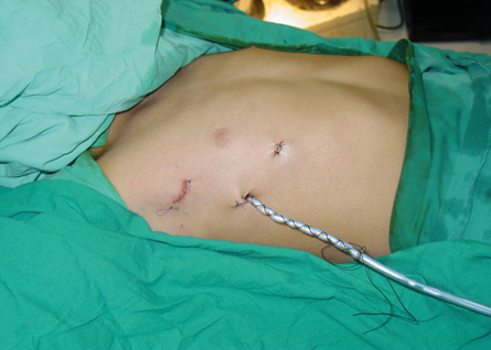 Myasthenia Gravis