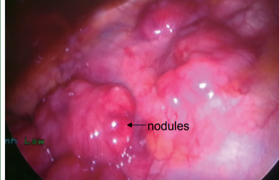 Malignant Mesothelioma