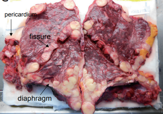 Malignant Mesothelioma