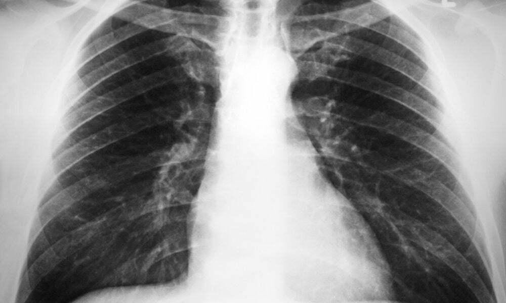 Konjenital Kistik Adenomatoid Malformasyon nedir Konjenital Kistik Adenomatoid Malformasyon nedir