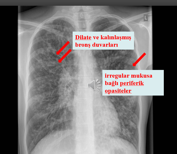 bronşektazi cerrahisi bronşektazi cerrahisi