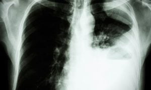 lung metastasis lung metastasis